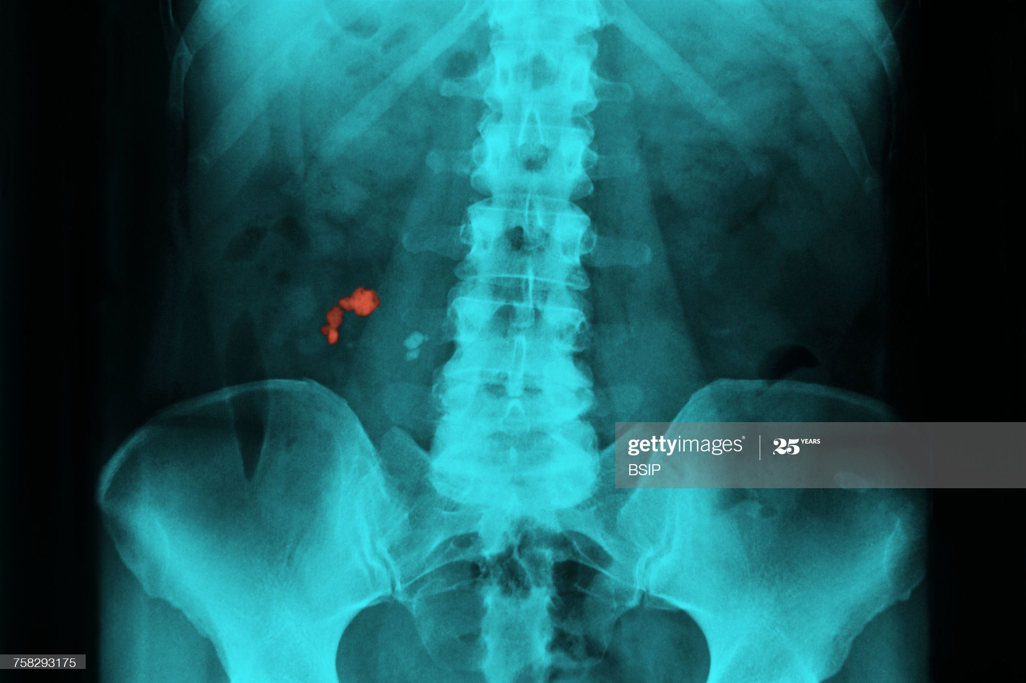 Renal lithiasis,x-ray
